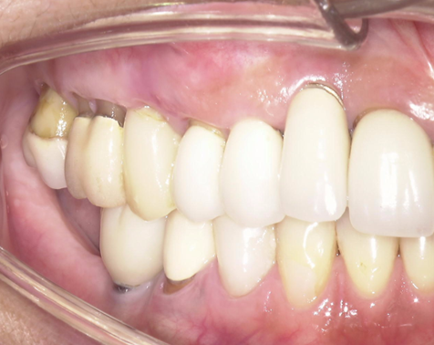 骨造成+サイナスリフトとインプラント治療2-1