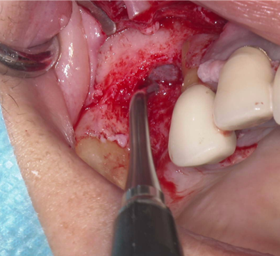 骨造成+サイナスリフトとインプラント治療2-5