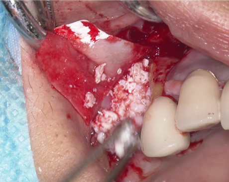 骨造成+サイナスリフトとインプラント治療2-6