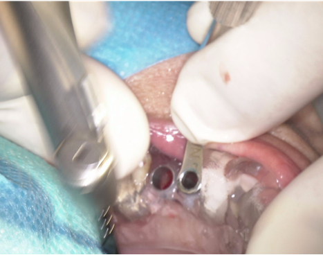 骨造成+サイナスリフトとインプラント治療2-7