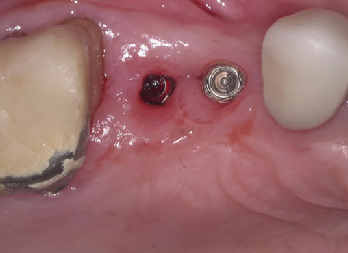 骨造成+サイナスリフトとインプラント治療2-8