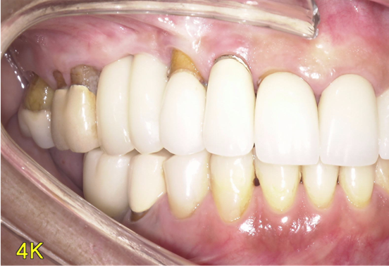 骨造成+サイナスリフトとインプラント治療2-9