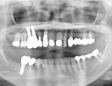 骨造成+サイナスリフトとインプラント治療2-9