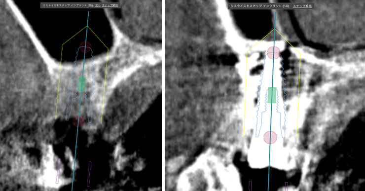 骨造成+サイナスリフトとインプラント治療2-9