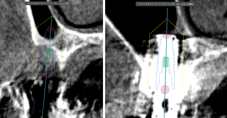 骨造成+サイナスリフトとインプラント治療2-9